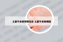 兒童牛皮癬初期征兆 兒童牛皮癬病因