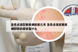急性點(diǎn)滴型銀屑病脫屑幾天 急性點(diǎn)滴狀銀屑病好轉(zhuǎn)的癥狀是什么