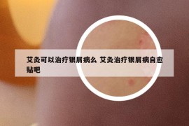 艾灸可以治療銀屑病么 艾灸治療銀屑病自愈貼吧