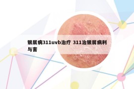 銀屑病311uvb治療 311治銀屑病利與害