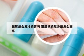 銀屑病會(huì)發(fā)冷感冒嗎 銀屑病感覺冷是怎么回事
