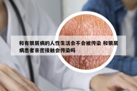 和有銀屑病的人性生活會(huì)不會(huì)被傳染 和銀屑病患者親密接觸會(huì)傳染嗎