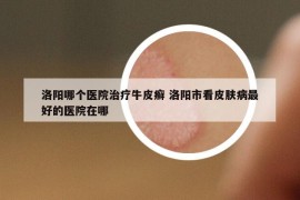 洛陽哪個醫(yī)院治療牛皮癬 洛陽市看皮膚病最好的醫(yī)院在哪