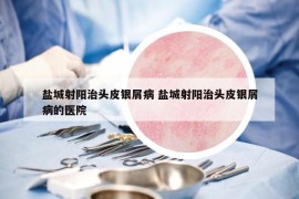 鹽城射陽治頭皮銀屑病 鹽城射陽治頭皮銀屑病的醫(yī)院