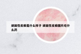 頑固性皮癬是什么樣子 頑固性皮癬圖片吃什么藥