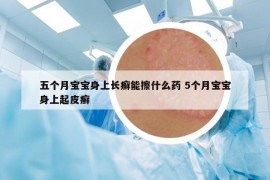 五個月寶寶身上長癬能擦什么藥 5個月寶寶身上起皮癬