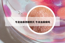 牛皮血癬初期照片 牛皮血癬癢嗎