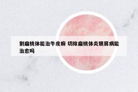 割扁桃體能治牛皮癬 切除扁桃體炎銀屑病能治愈嗎
