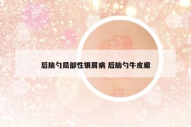 后腦勺局部性銀屑病 后腦勺牛皮廨