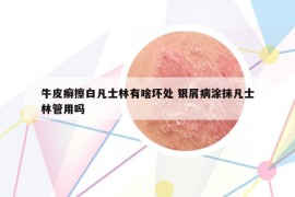 牛皮癬擦白凡士林有啥壞處 銀屑病涂抹凡士林管用嗎