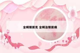 全蝎銀屑克 全蝎治銀屑病