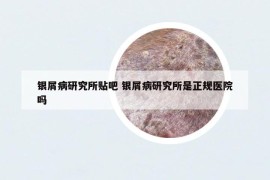 銀屑病研究所貼吧 銀屑病研究所是正規(guī)醫(yī)院嗎