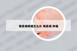 銀屑病疼痛怎么辦 銀屑病 腫痛