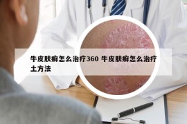 牛皮膚癬怎么治療360 牛皮膚癬怎么治療土方法