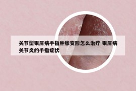 關節(jié)型銀屑病手指腫脹變形怎么治療 銀屑病關節(jié)炎的手指癥狀