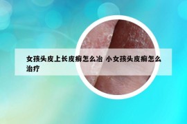 女孩頭皮上長皮癬怎么冶 小女孩頭皮癬怎么治療