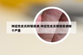 神經(jīng)性皮炎轉(zhuǎn)銀屑病 神經(jīng)性皮炎跟銀屑病哪個嚴重