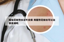 醋加花椒熬水治牛皮癬 用醋熬花椒水可以治銀屑病嗎