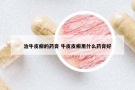 治牛皮癬的藥膏 牛皮皮癬用什么藥膏好