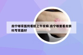 南寧哪家醫(yī)院看臉上牛皮癬 南寧哪里看皮膚科專家最好