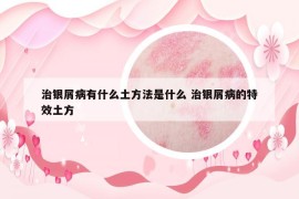 治銀屑病有什么土方法是什么 治銀屑病的特效土方
