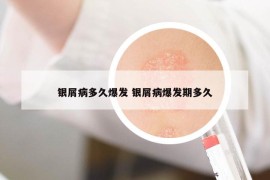 銀屑病多久爆發(fā) 銀屑病爆發(fā)期多久
