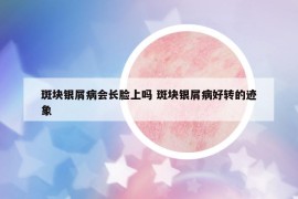 斑塊銀屑病會(huì)長(zhǎng)臉上嗎 斑塊銀屑病好轉(zhuǎn)的跡象