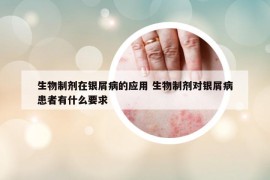 生物制劑在銀屑病的應(yīng)用 生物制劑對(duì)銀屑病患者有什么要求