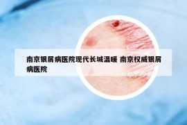 南京銀屑病醫(yī)院現(xiàn)代長(zhǎng)城溫暖 南京權(quán)威銀屑病醫(yī)院