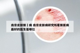 南京皮膚銀痟病 南京皮膚病研究所看銀屑病最好的醫(yī)生是哪位