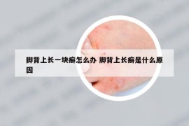 腳背上長一塊癬怎么辦 腳背上長癬是什么原因
