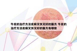 牛皮的治療方法皮癬又快又好的偏方 牛皮的治療方法皮癬又快又好的偏方有哪些