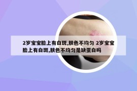 2歲寶寶臉上有白斑,膚色不均勻 2歲寶寶臉上有白斑,膚色不均勻是缺蛋白嗎