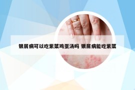 銀屑病可以吃紫菜雞蛋湯嗎 銀屑病能吃紫菜