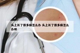 頭上長了很多癬怎么辦 頭上長了很多癬怎么辦啊