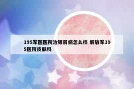 195軍醫(yī)醫(yī)院治銀屑病怎么樣 解放軍195醫(yī)院皮膚科