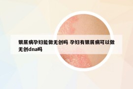 銀屑病孕婦能做無創(chuàng)嗎 孕婦有銀屑病可以做無創(chuàng)dna嗎