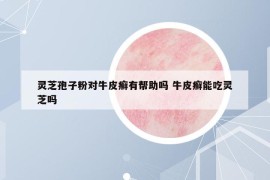 靈芝孢子粉對牛皮癬有幫助嗎 牛皮癬能吃靈芝嗎