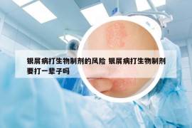 銀屑病打生物制劑的風(fēng)險 銀屑病打生物制劑要打一輩子嗎