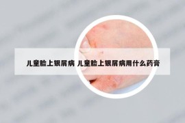 兒童臉上銀屑病 兒童臉上銀屑病用什么藥膏