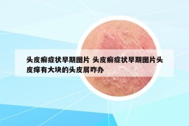 頭皮癬癥狀早期圖片 頭皮癬癥狀早期圖片頭皮癢有大塊的頭皮屑咋辦