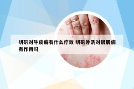 明礬對(duì)牛皮癬有什么療效 明礬外洗對(duì)銀屑病有作用嗎