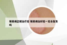 銀屑病正規(guī)治療后 銀屑病治好后一定會復(fù)發(fā)嗎