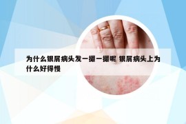 為什么銀屑病頭發(fā)一撮一撮呢 銀屑病頭上為什么好得慢