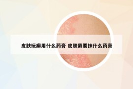 皮膚玩癬用什么藥膏 皮膚蘚要抹什么藥膏