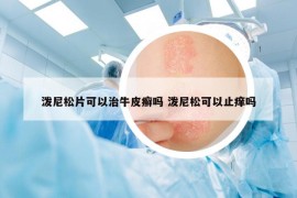 潑尼松片可以治牛皮癬嗎 潑尼松可以止癢嗎