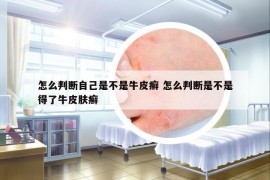 怎么判斷自己是不是牛皮癬 怎么判斷是不是得了牛皮膚癬
