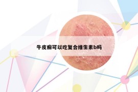牛皮癬可以吃復(fù)合維生素b嗎