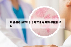 銀屑病能治好嗎問詢西安北方 銀屑病醫(yī)得好嗎