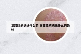 掌跖膿皰病抹什么藥 掌跖膿皰病抹什么藥最好